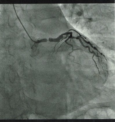 左冠動脈造影（３０．４．19)十分の一.jpg
